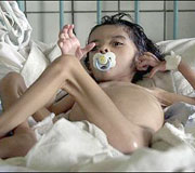 desnutrici�n infantil